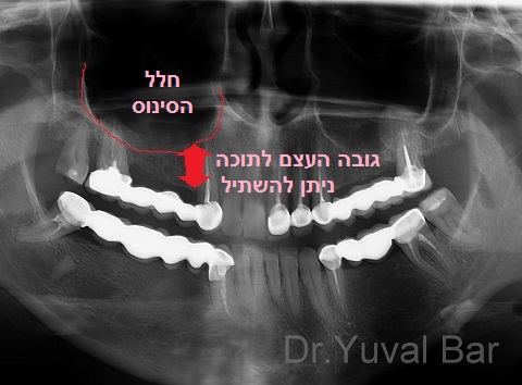 ניתוח הרמת סינוס